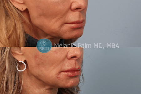 Restylane Kysse before and after art of skin md