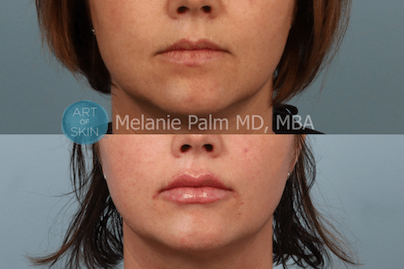 before and after vollure to lips art of skin md
