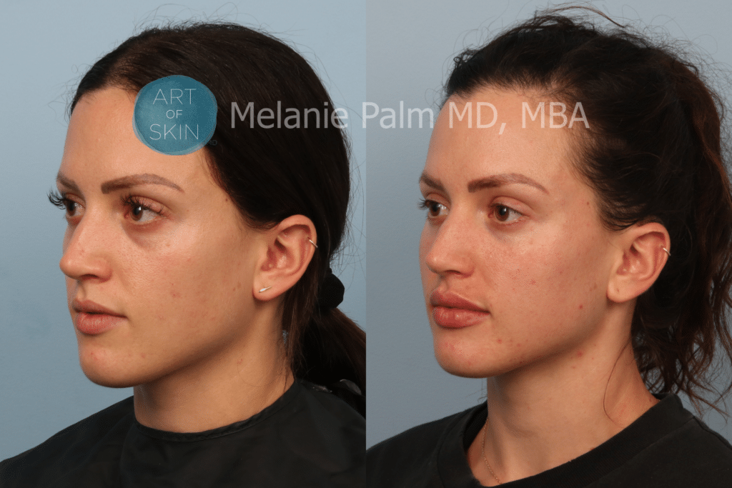 art of skin md san diego before and after restylane lyft