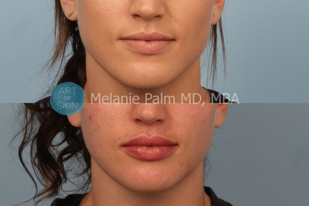 art of skin md san diego restylane kysse before and after lips
