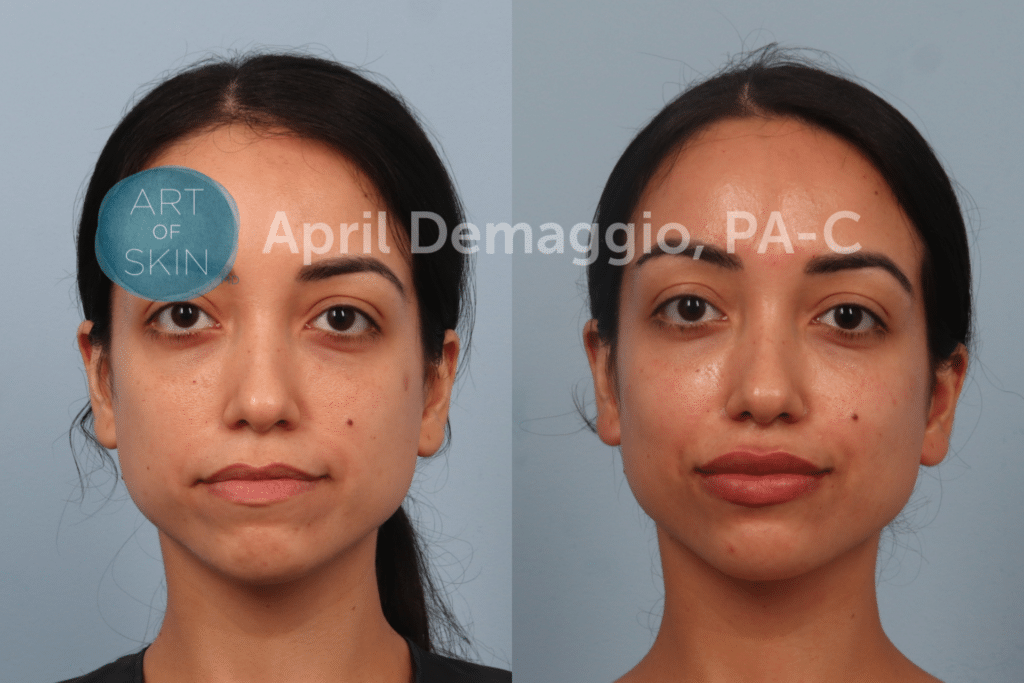 before and after Restylane Kysse art of skin md