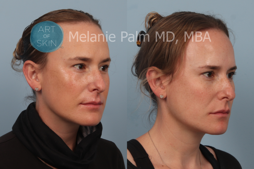 art of skin md before after Restylane Tear trough right