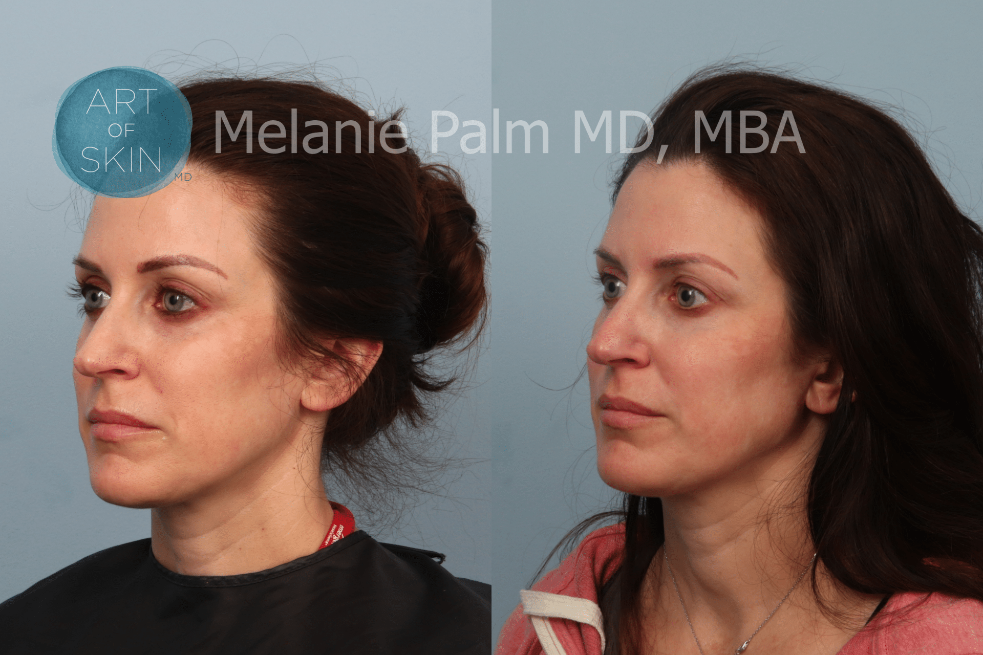 B&A Restylane To Under Eye Area Lt Quarter View