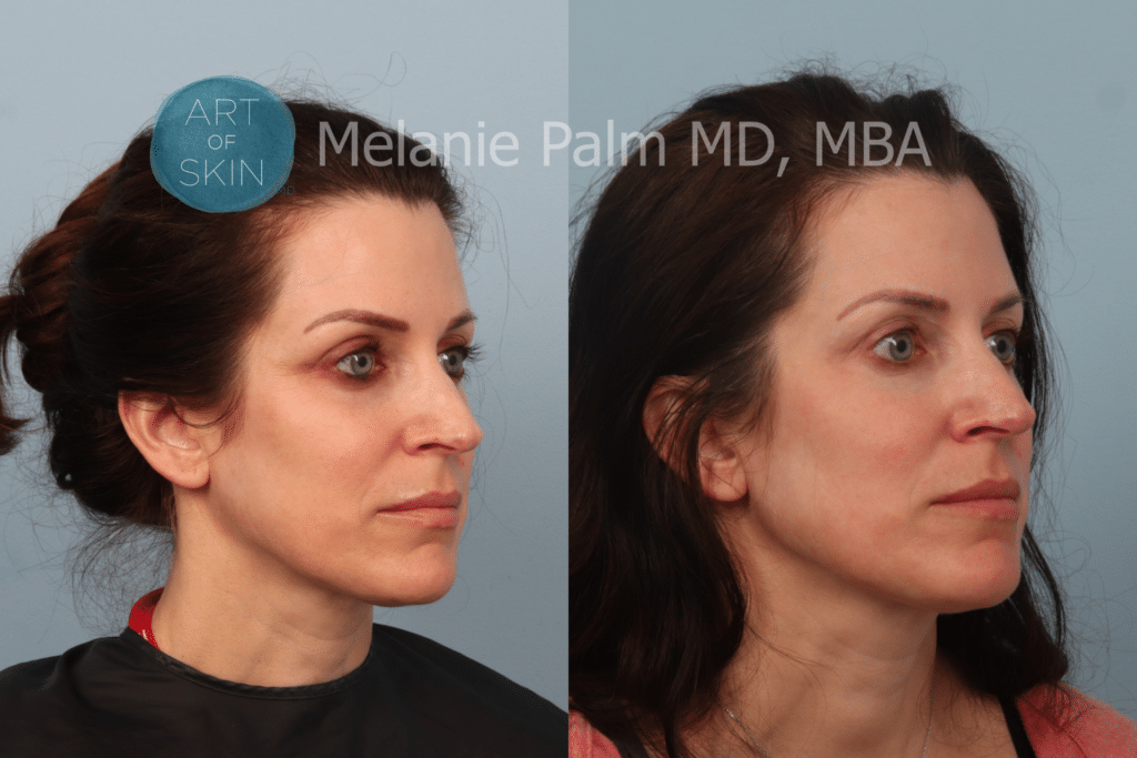 Art of skin md B&A Restylane to under eye area