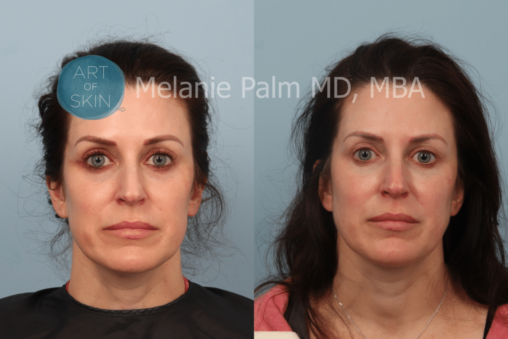 Art of skin md B&A Restylane to under eye area