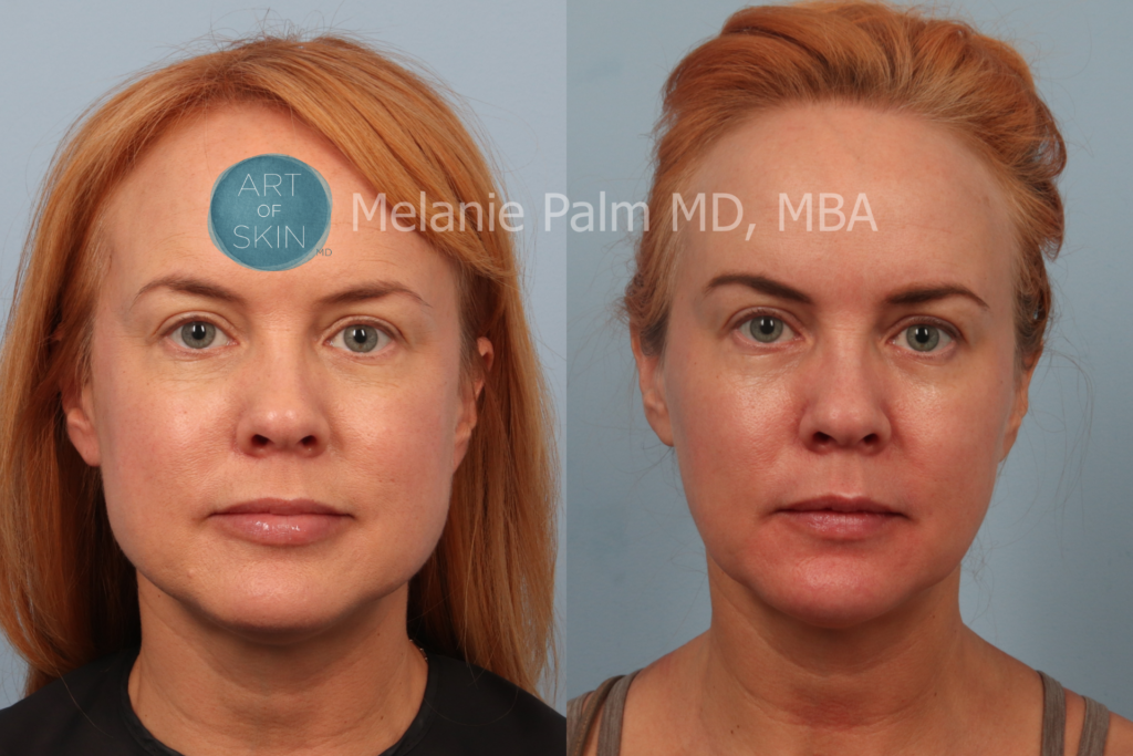 art of skin md before after Dysport masseters lower jaw