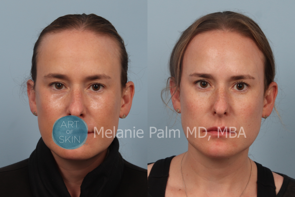 art of skin md before after Restylane Tear trough front view