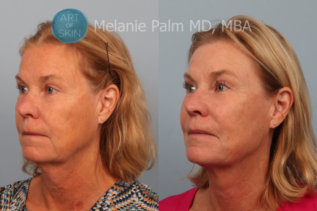 art of skin md before & after instalift 92920