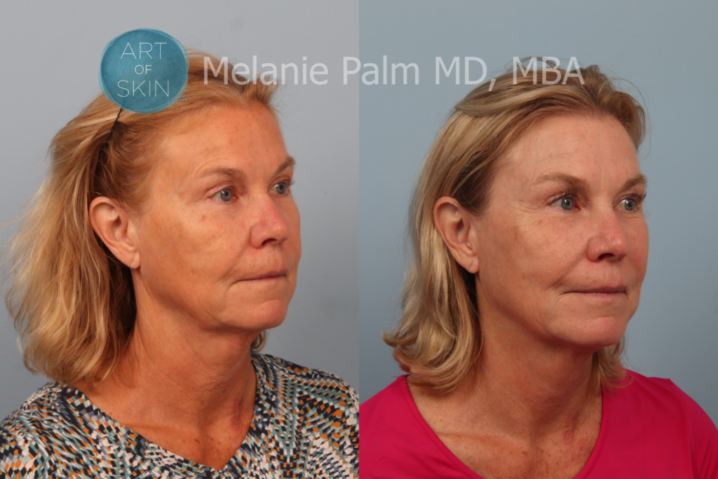 art of skin md before & after instalift 92920