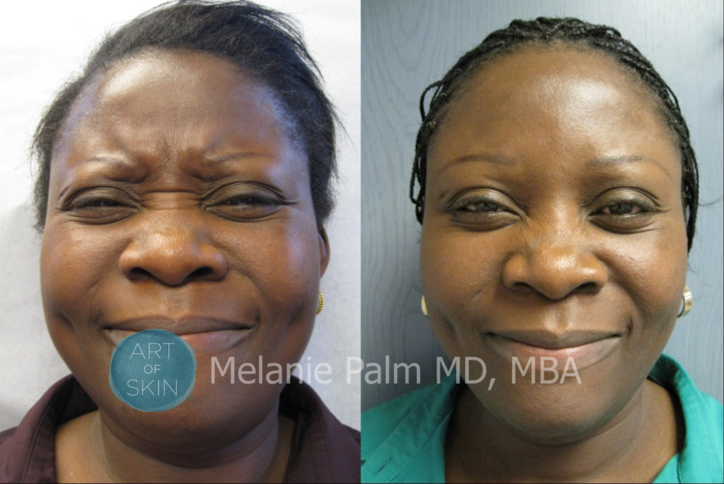 art of skin md dysport to frown lines glabella before after