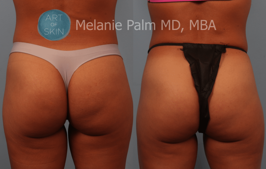 Radiesse to buttock region