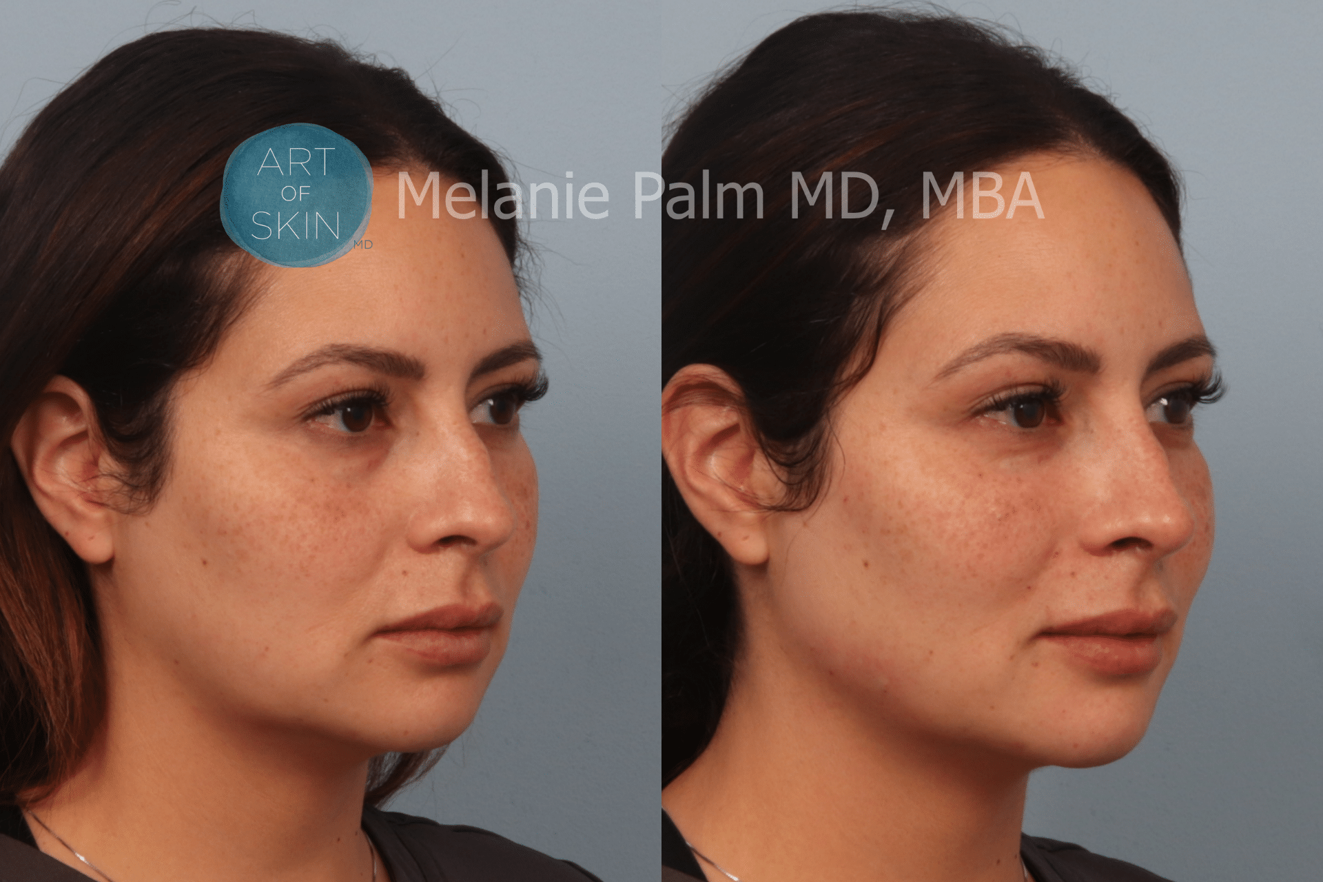 Restylane Nasal Shaping Teartrough