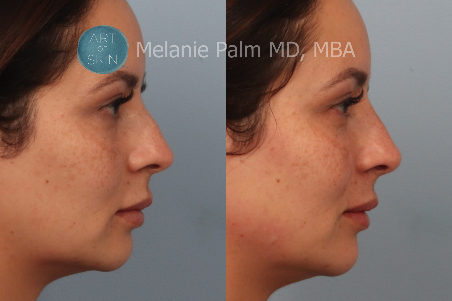 Restylane Nasal Shaping Teartrough
