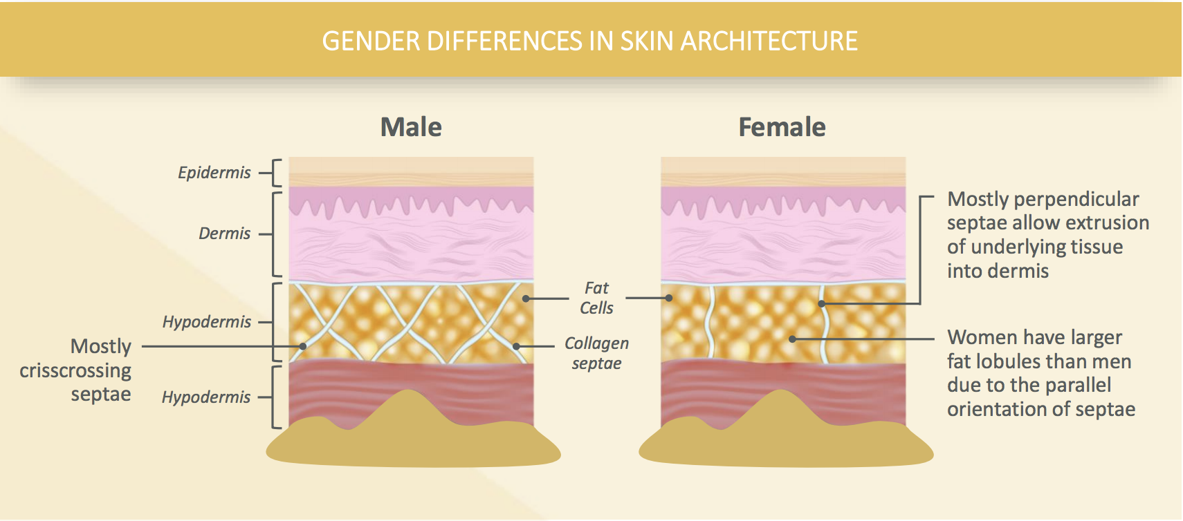 Men versus women with cellulite