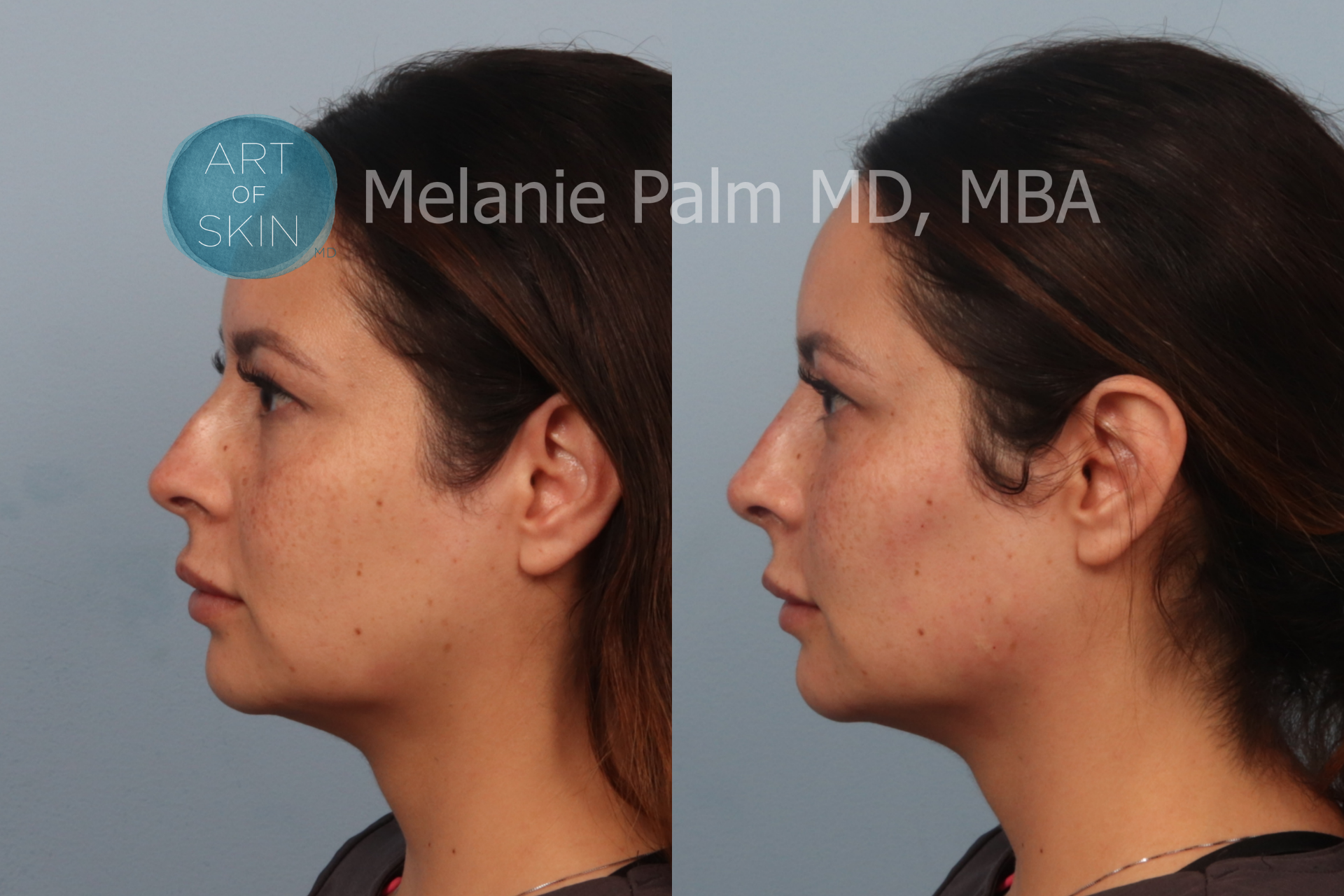 Left Side View Restylane Nasal Shaping Tear Trough