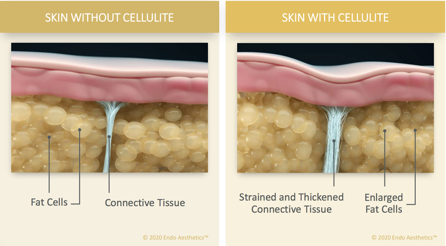 Cellulite Causes Cellulite Treatment Options Qwo San Diego