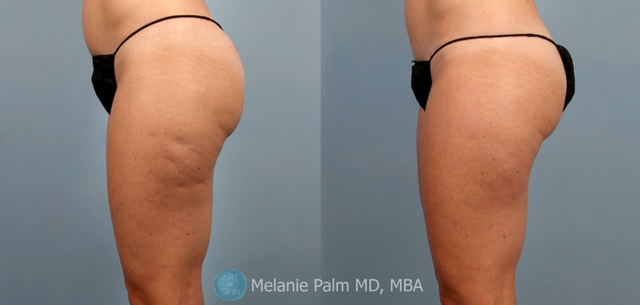 CELLFINA Treatment to dimples on thighs