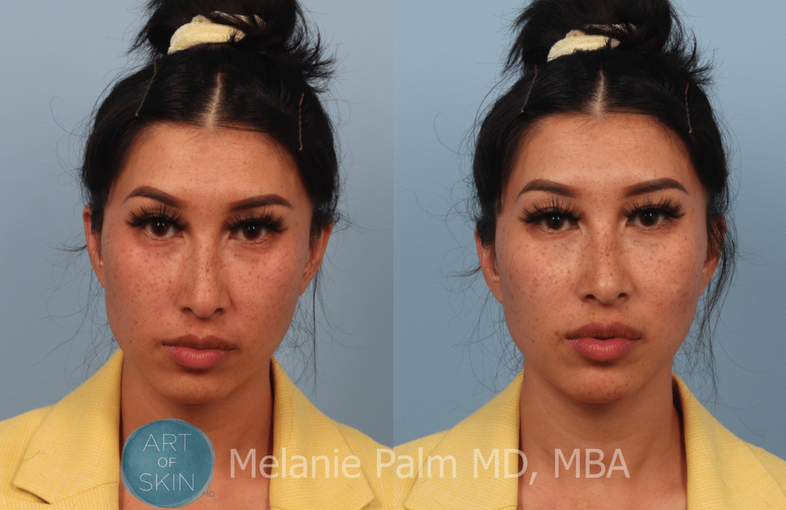 Restylane Contour Cheek Filler Injections San Diego