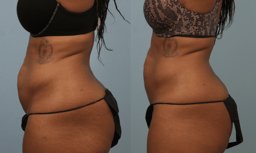 art of skin md Emtone Abdomen before and after