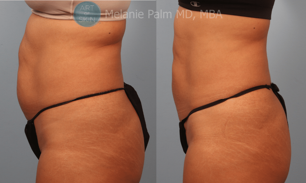 art of skin md coolsculpting before and after abdomen