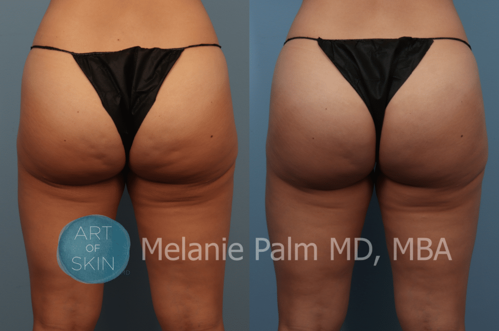 art of skin md qwo before and after buttocks