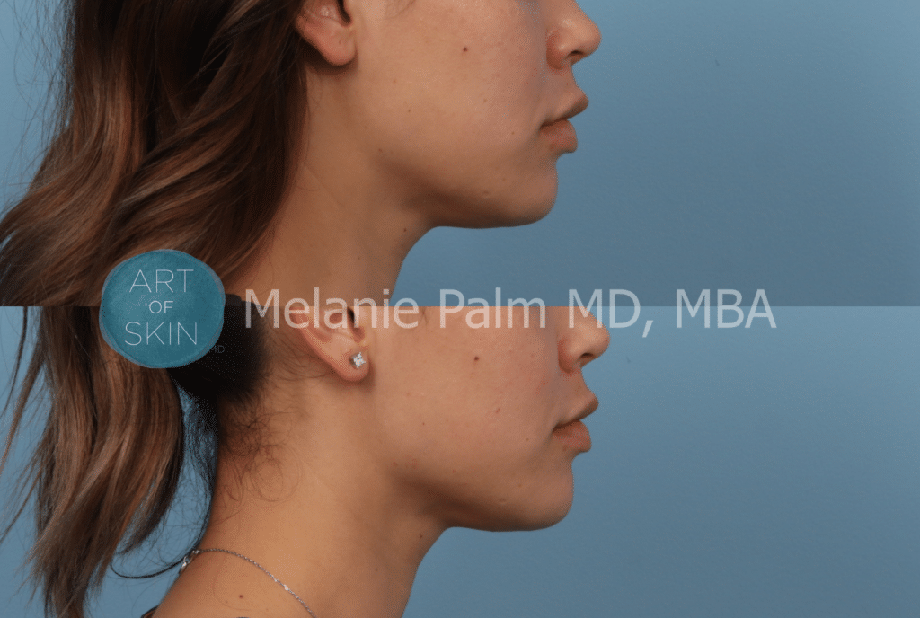 art-of-skin-md-radiesse-jawline-before-and-after