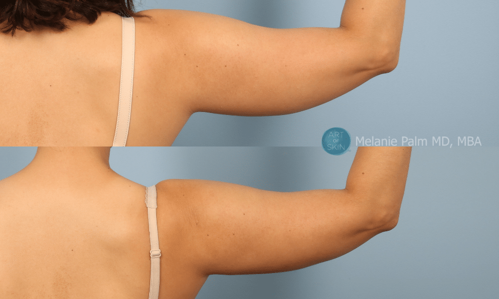 art of skin md coolsculpting before and after arms