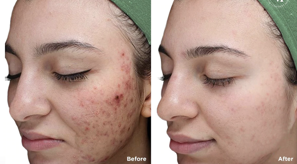art of skin md vi peel before and after