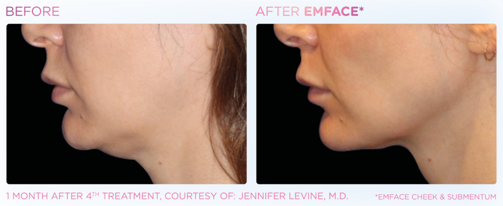 art of skin md emface submentum chin enhancement before and after
