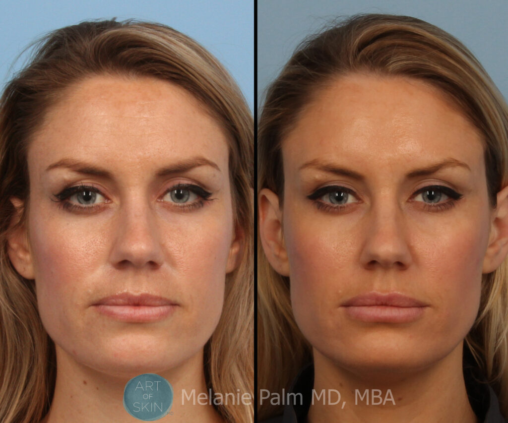 art of skin md sculptra before and after photos face