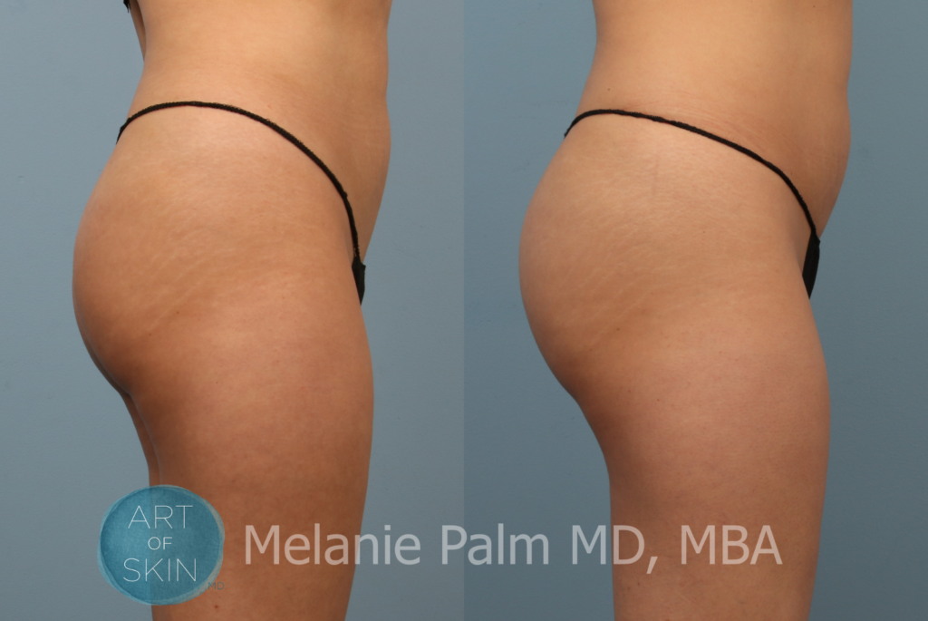 art of skin md sculptra before and after photos buttocks