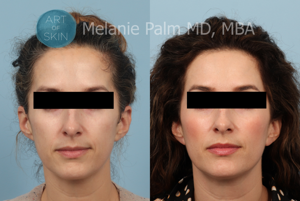 art of skin md sculptra before and after photos face