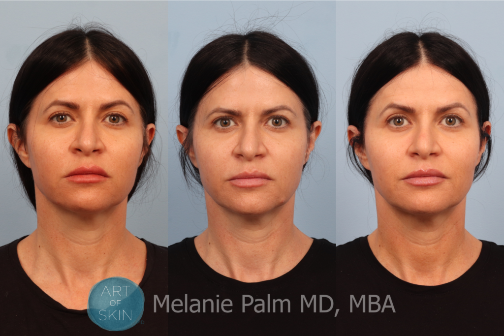 art of skin md emface before and after