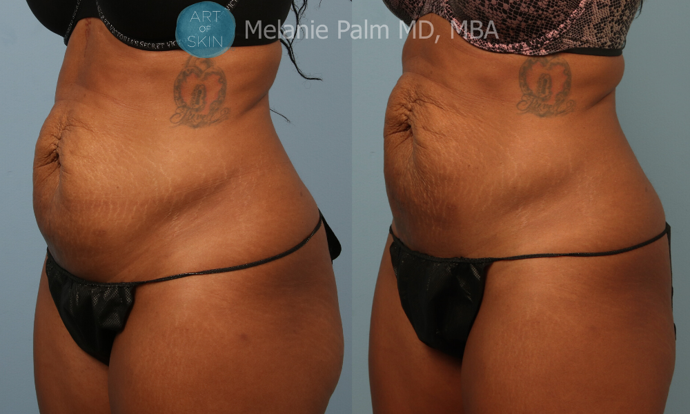 art of skin md emtone before and after