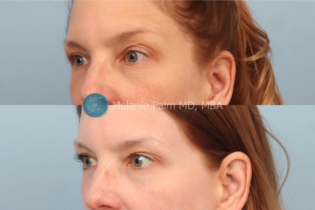 art of skin md exilis before and after