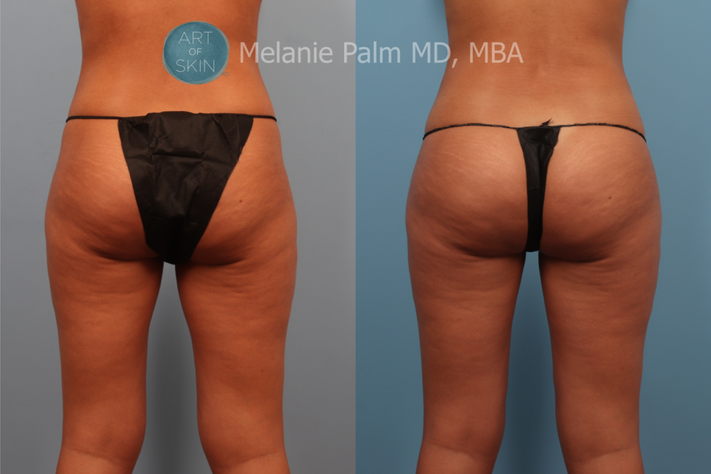 art of skin md coolsculpting before and after