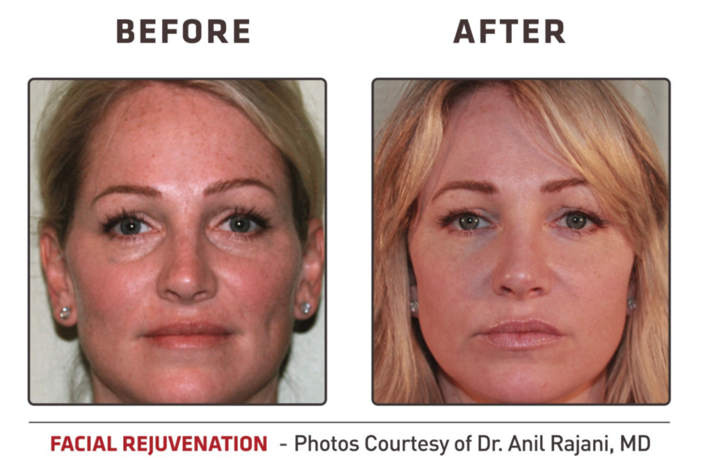 art of skin md ez gel prf before and after