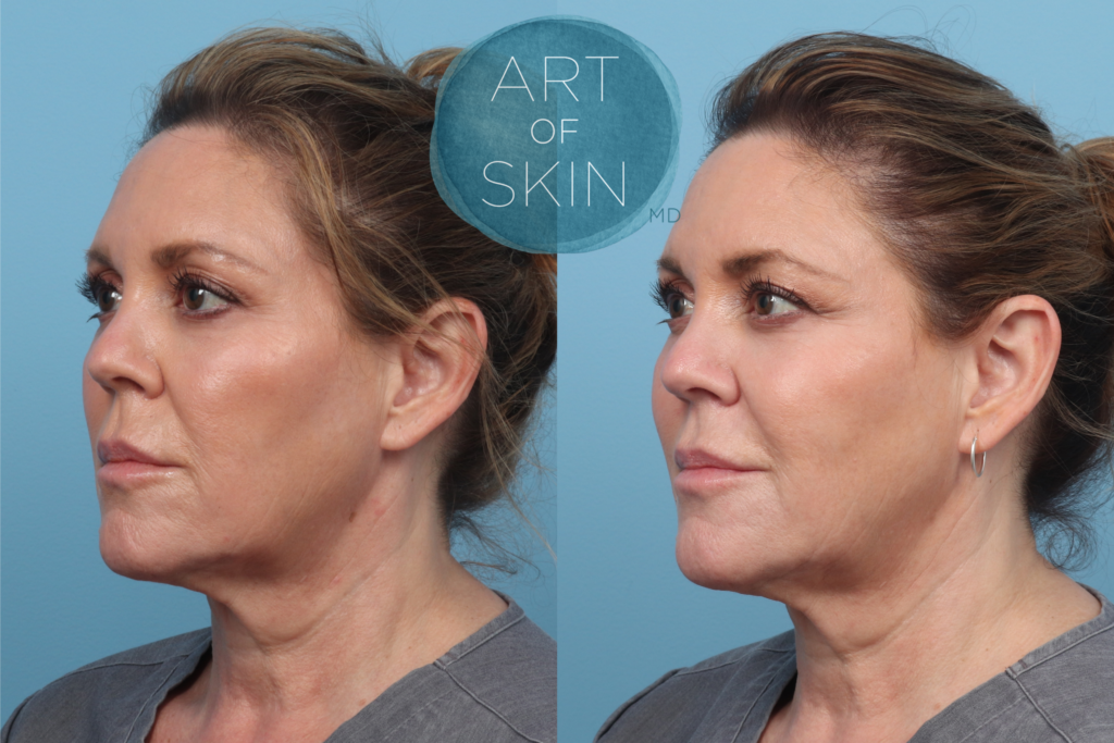 art of skin md skinvive before and after