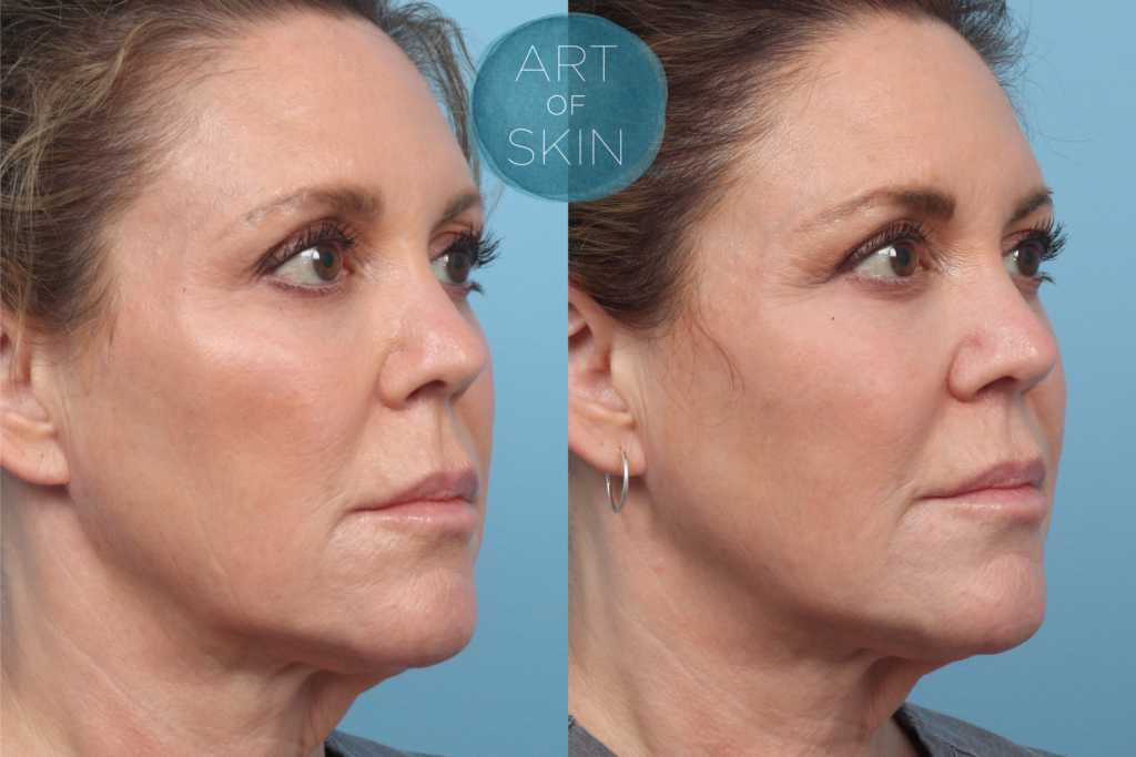 art of skin md skinvive before and after