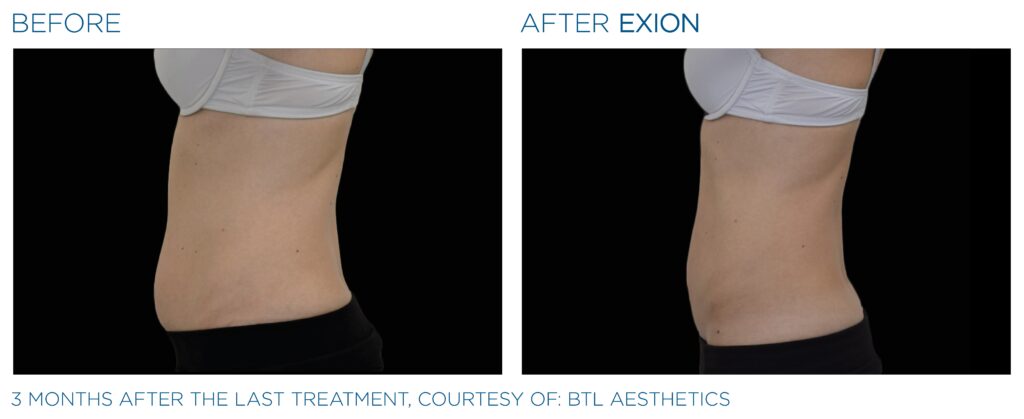 Art of Skin MD EXION before and after abdomen