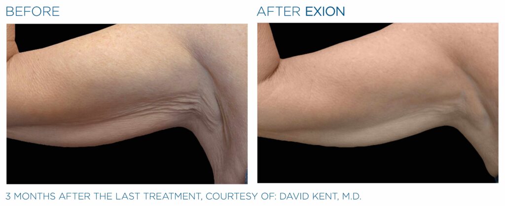 Art of Skin MD EXION before and after arms