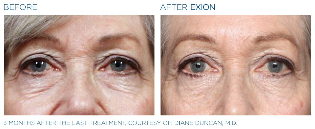 Art of Skin MD EXION before and after eyes