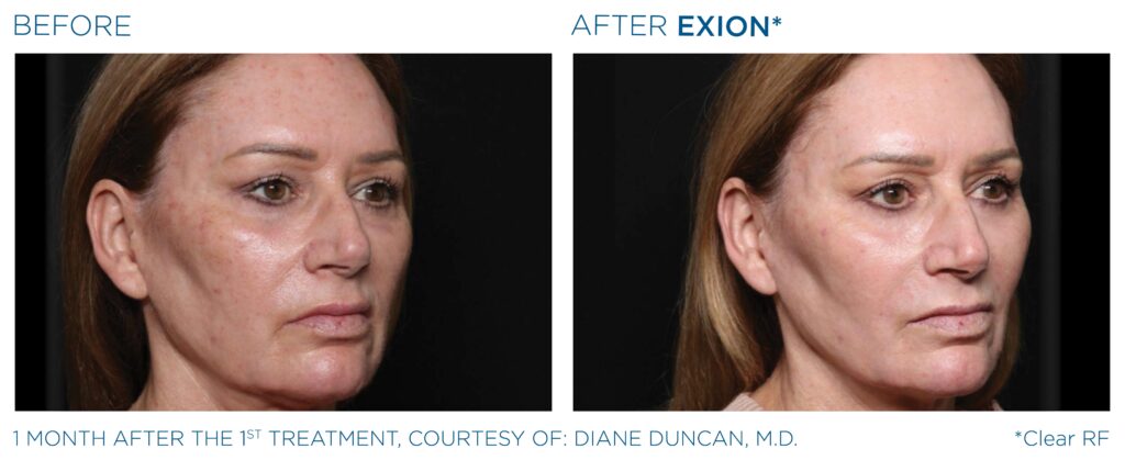 Art of Skin MD EXION before and after face