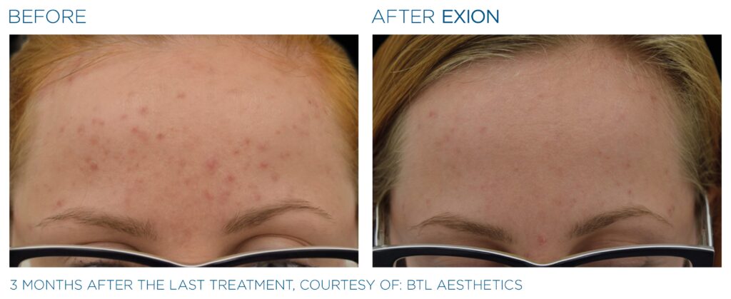 Art of Skin MD EXION before and after forehead