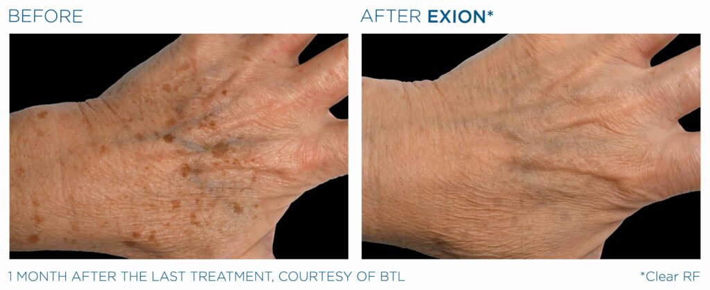 Art of Skin MD EXION before and after hands