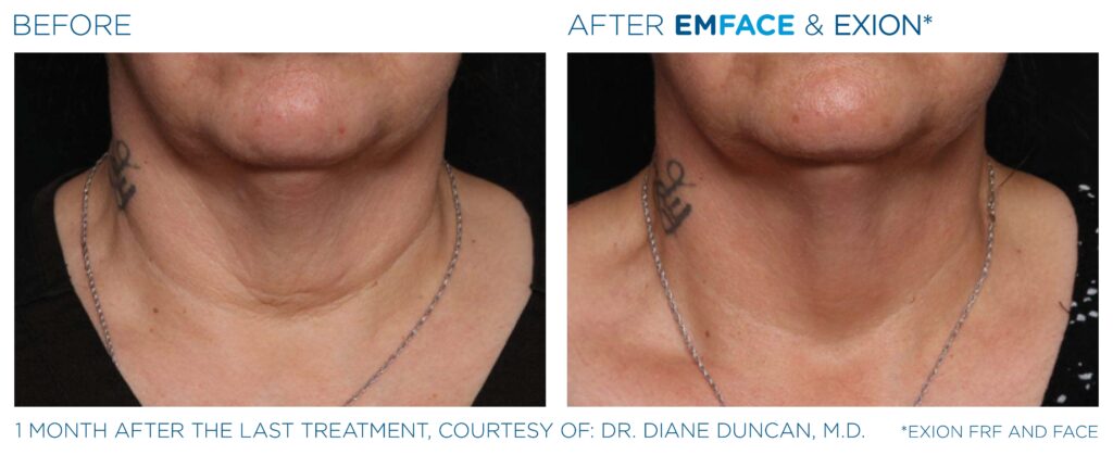 Art of Skin MD EXION before and after neck