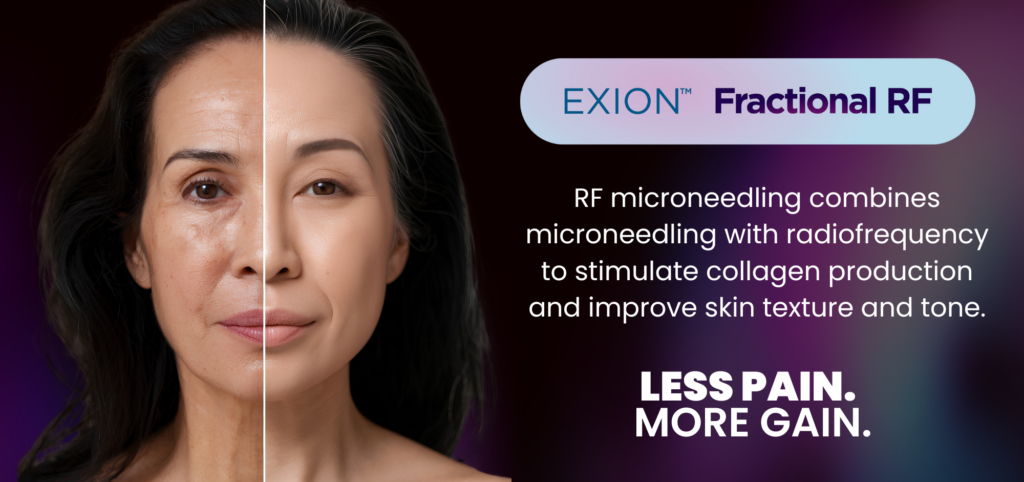 art of skin md exion clear rf microneedling