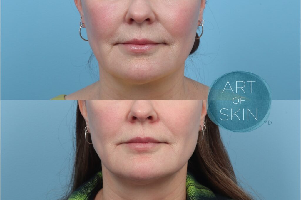 art of skin md skinvive by juvederm before and after