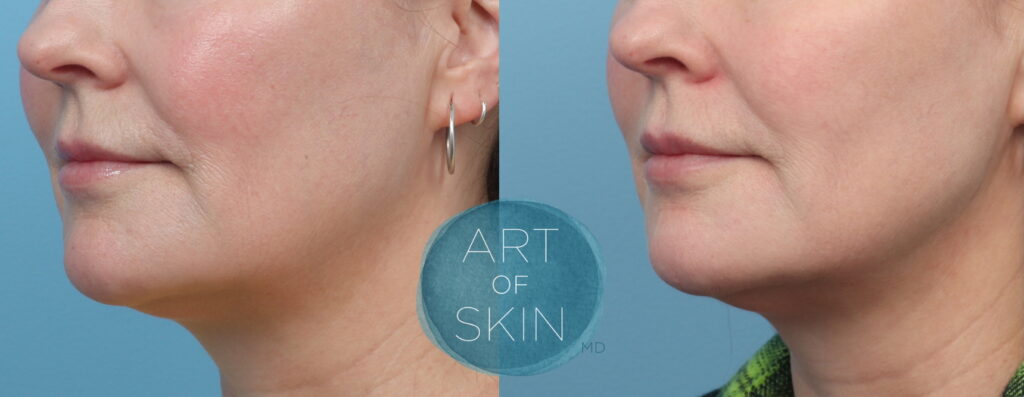 art of skin md skinvive by juvederm before and after