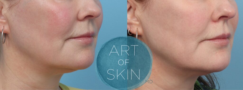 art of skin md skinvive by juvederm before and after